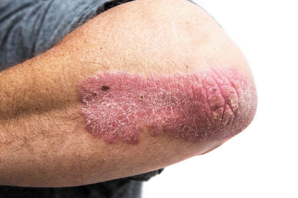 Psoriasis 4 Psoriasis