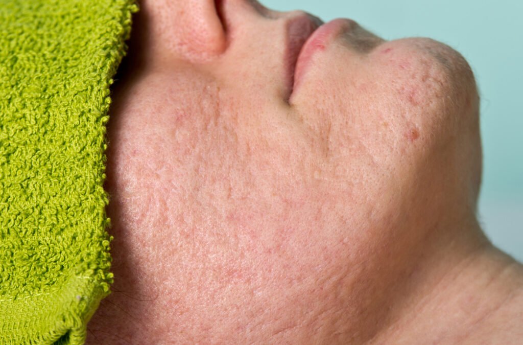 Acne and Acne Scar Treatment 5 Acne Acne Scar