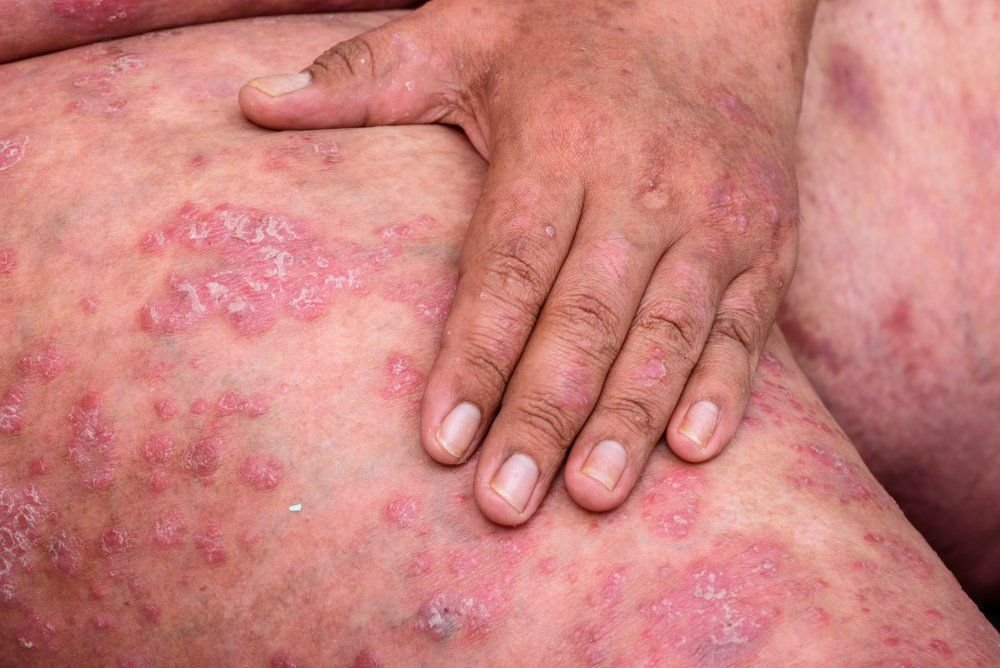 Psoriasis 3 2