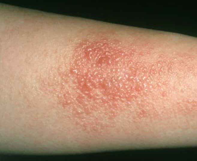 Allergic Contact Dermatitis Treatment 2 Allergic Contact Dermatitis Treatment2