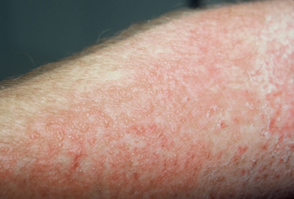 Allergic Contact Dermatitis Treatment 4 Allergic Contact Dermatitis Treatment23