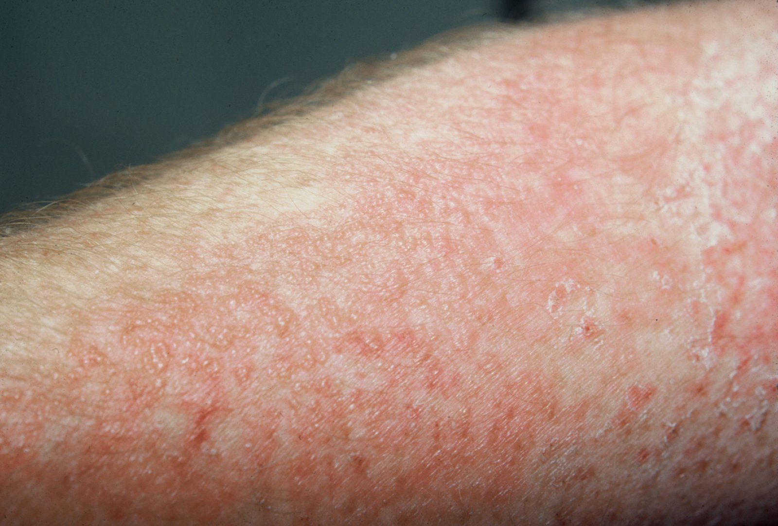 Allergic Contact Dermatitis Treatment 3 Allergic Contact Dermatitis Treatment23