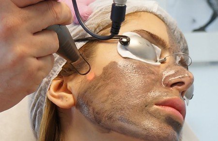 Carbon laser peel2 1