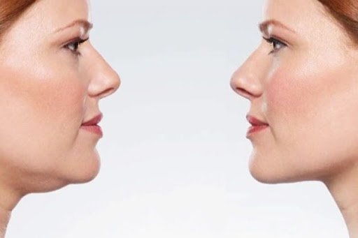 Double Chin Treatment1