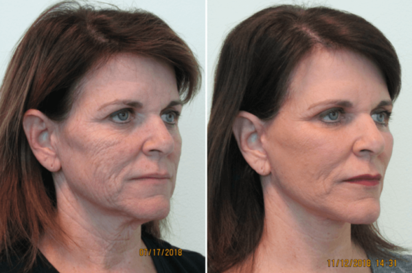 Fractional CO2 Laser Treatment 2 FRACTIONAL CO2 TREATMENTS1