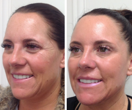 Fractional CO2 Laser Treatment 3 FRACTIONAL CO2 TREATMENTS23