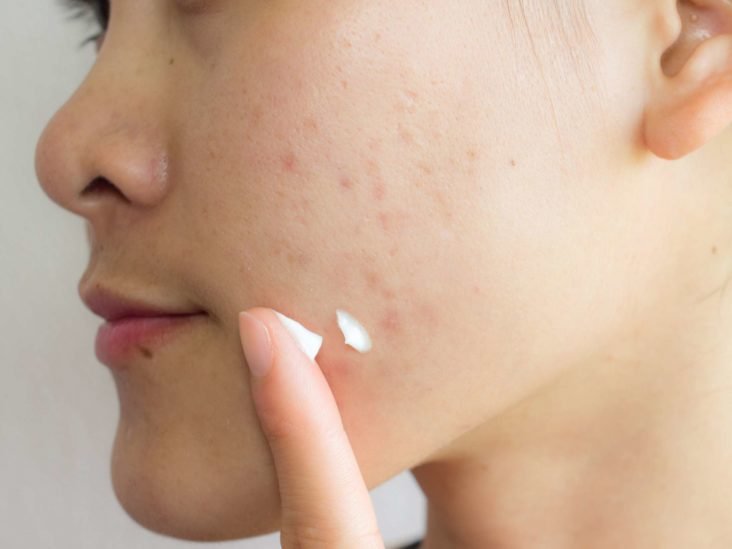 Freckles and Blemishes3