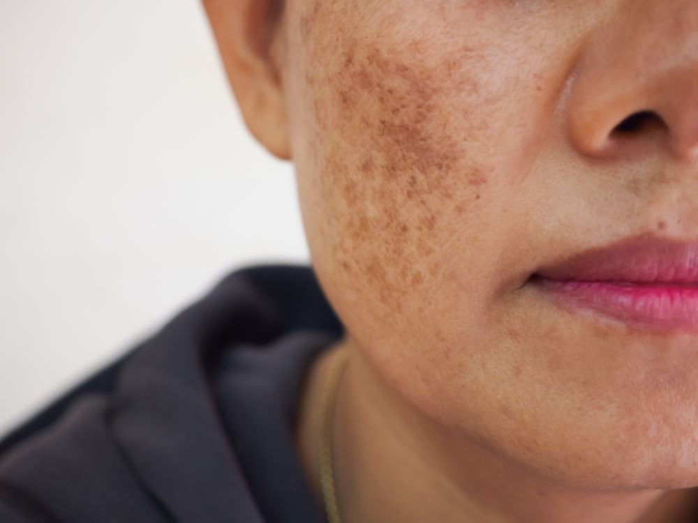 Freckles and Blemishes4