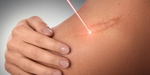 Keloids Treatment 4 Keloids Treatment1