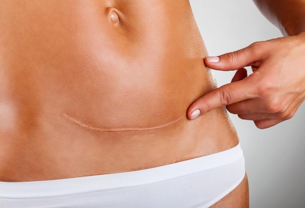 Keloids Treatment 3 Keloids Treatment3