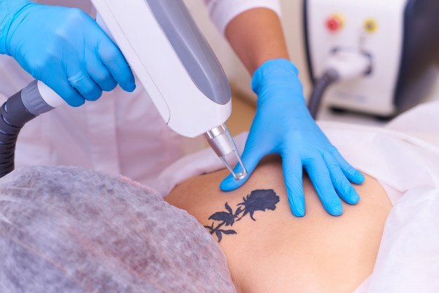 Laser Tattoo Removal Treatment 2 LASER TATTOO REMOVAL TREATMENT2