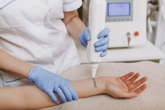 Laser Tattoo Removal Treatment 3 LASER TATTOO REMOVAL TREATMENT3