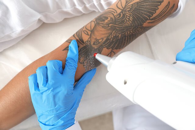 Laser Tattoo Removal Treatment 4 LASER TATTOO REMOVAL TREATMENT4