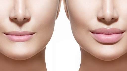 Lip Reduction 4 Lip Reduction Treatment1