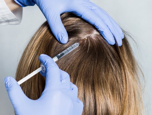 PRP for Hair loss 4 PRP for Hair loss2