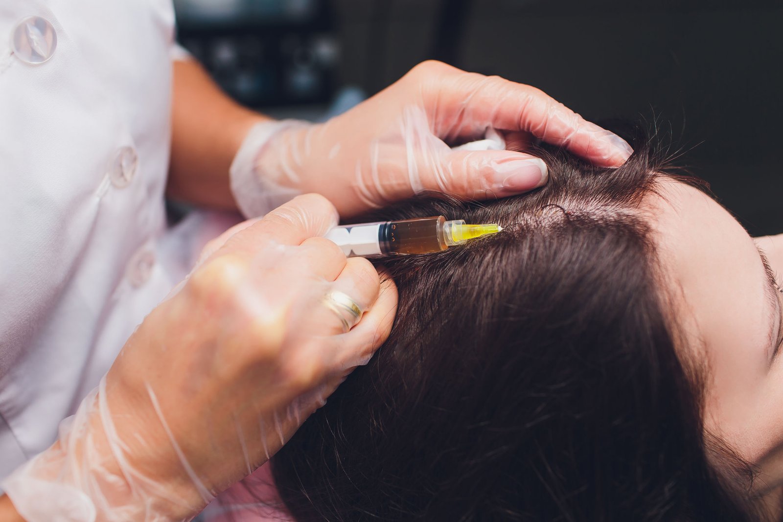 PRP for Hair loss 3 PRP for Hair loss3