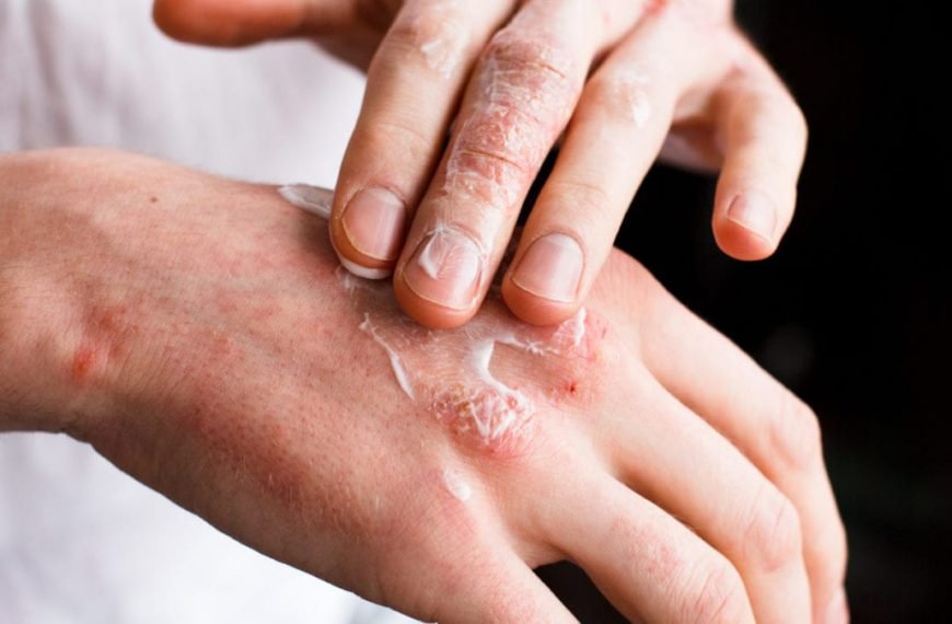 Psoriasis 2 PSORIASIS2