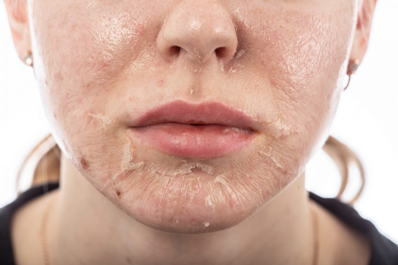 Chemical Skin Peels 3 Peeling skin