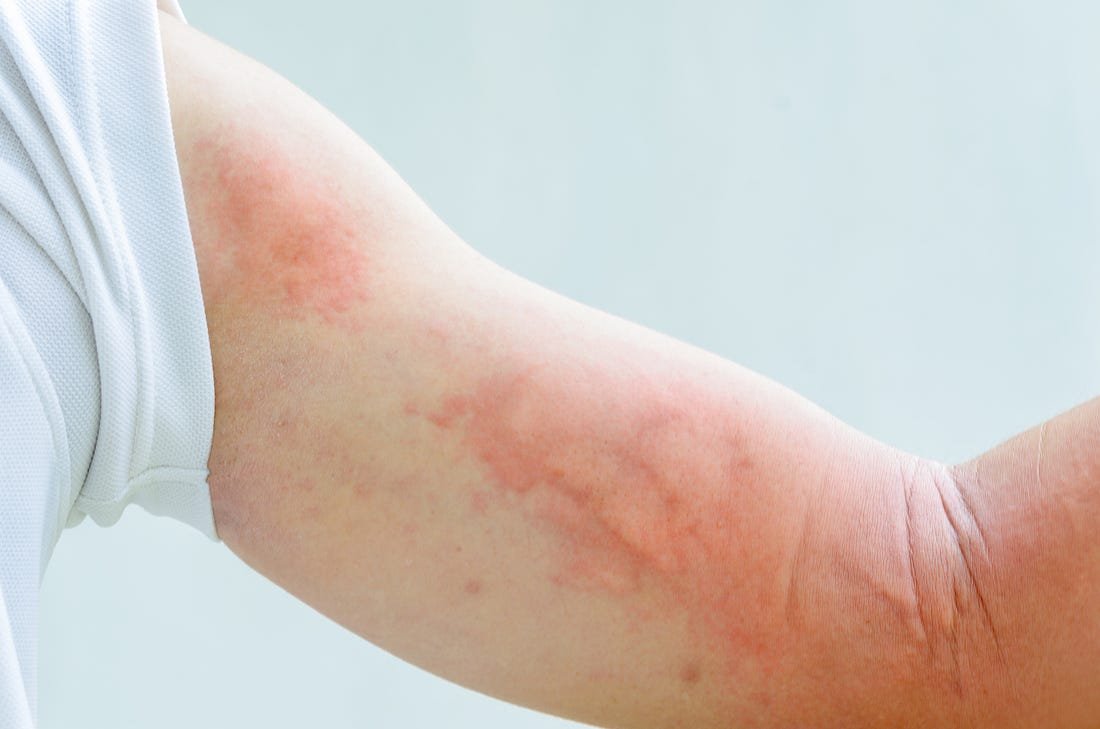Rashes 2 RASHES2
