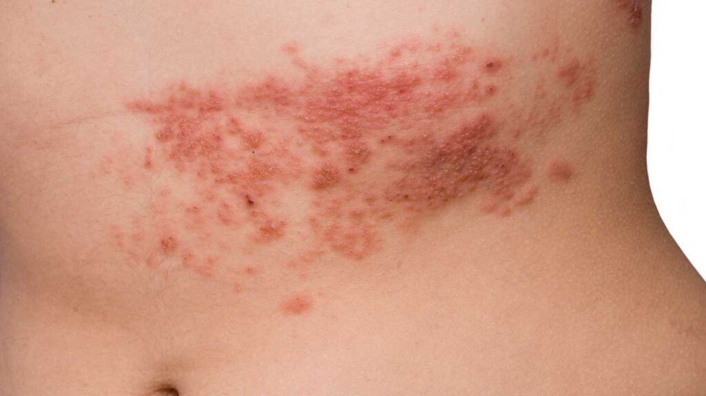 Rashes 4 RASHES3