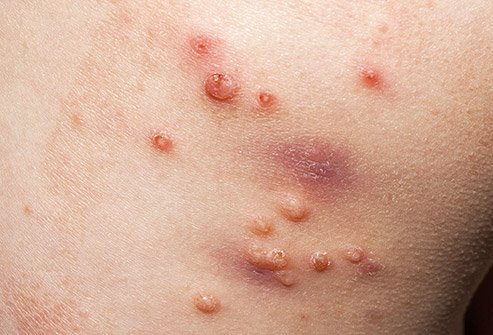 Skin Infection Treatment1