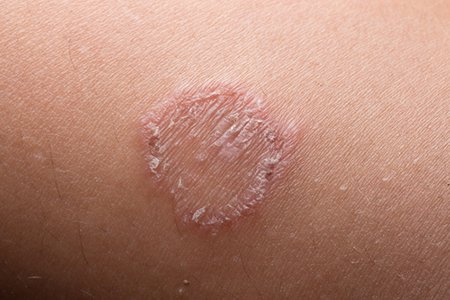 Skin Infections 2 Skin Infection Treatment2