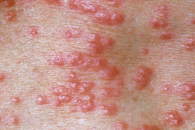 Skin Infections 4 Skin Infection Treatment3
