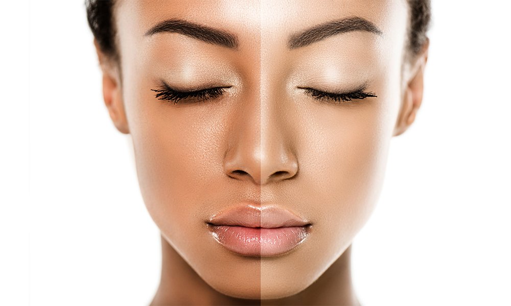 Skin Whitening 4 Skin Whitening Treatment2