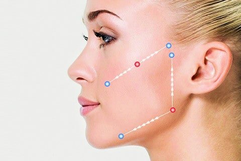 Thread Lifting Treatment 2 img gesicht fadenlifting l