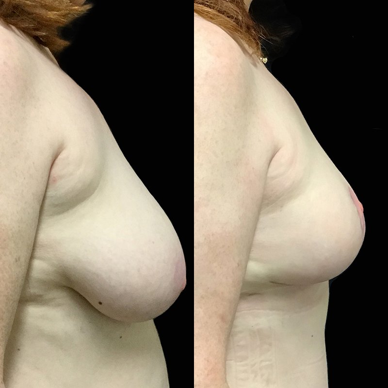 Breast Reduction Treatment 1