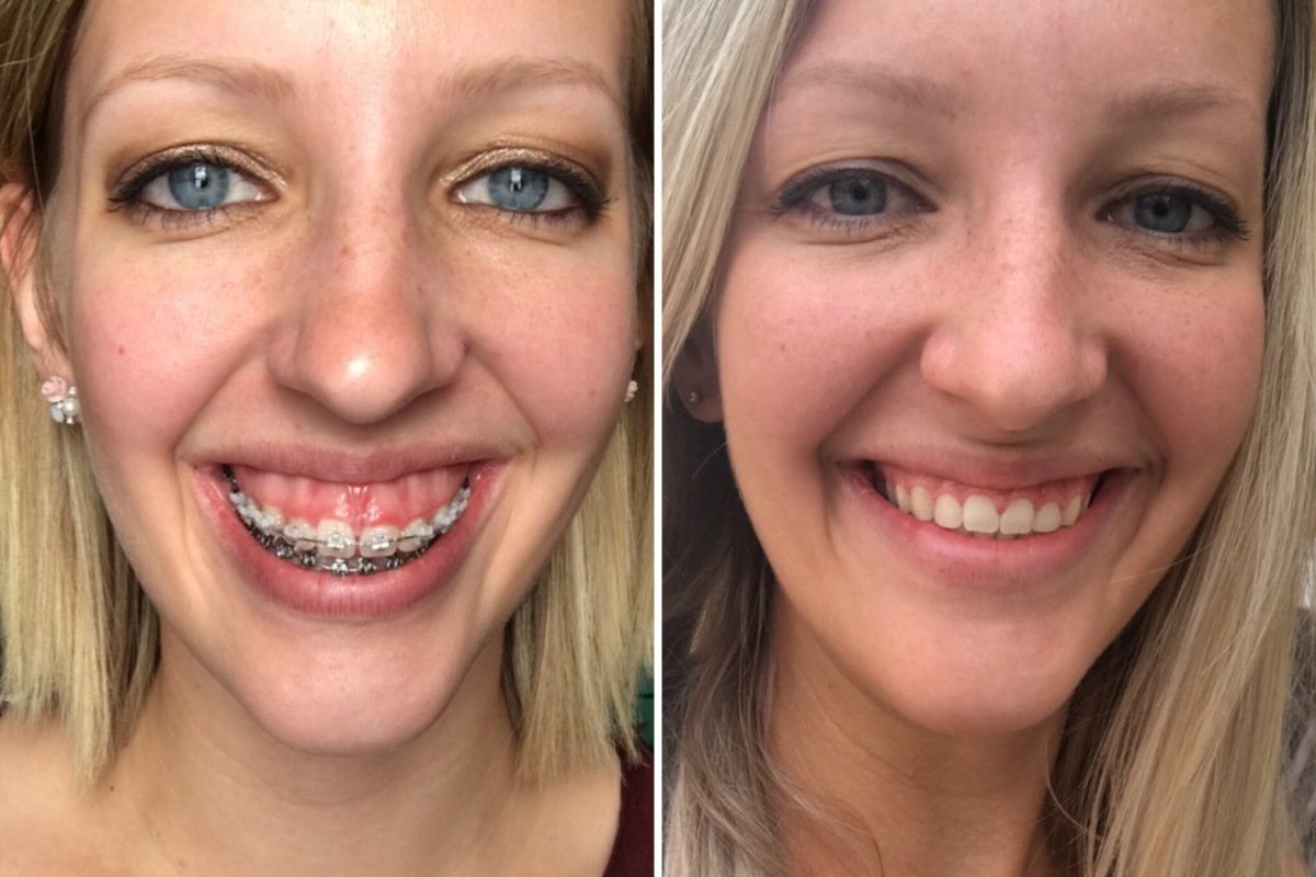 Gummy smile correction1