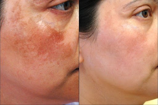 Pigmentation Treatment 1 Pigmentation Treatment1