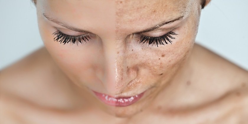 Pigmentation Treatment 2 Pigmentation Treatment2