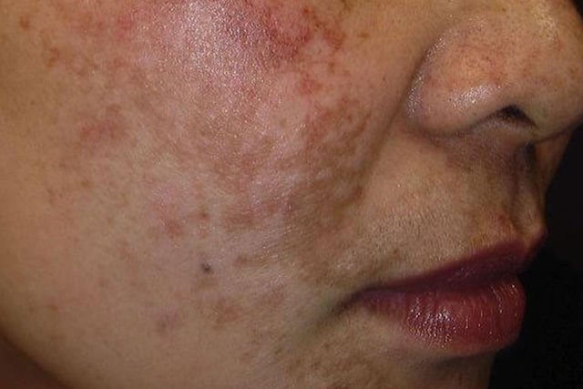 Pigmentation Treatment 3 Pigmentation Treatment3