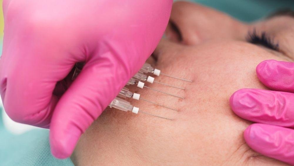 A thread lift is not meant for everyone, and an honest assessment is part of good aesthetic medicine. You may be a good candidate if: You are between 30 and 55 years old with mild to moderate skin sagging Your skin still has some natural elasticity (thread lifts do not work well on severely loose skin) You want a facelift-like result without surgery or long recovery You are in good general health with no active skin infections in the treatment area You have realistic expectations about results and their duration If your sagging is more advanced, Dr. Shumaila Khan may recommend combining a thread lift with other treatments, or advise a surgical option instead — this is discussed openly during your consultation at Dermalase.