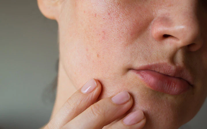 Winter skin issue and treatment in Islamabad by the best dermatologist