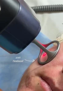Can You Get Laser Treatments During Summer or Monsoon? Safety Tips, Myths, and What Dermatologists Recommend 1 Acne Scar Laser Stacking Aesthetic Physician Islamabad