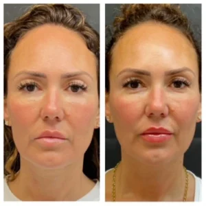 Non-Surgical Facelift Treatments 7 non surgical face lift in islamabad by dr shumaila khan in Dermalase Clinic F10 Islamabad
