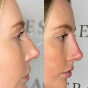 Non Surgical Rhinoplasty 904x904px 300x300 1